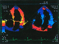 心臓超音波検査画像
